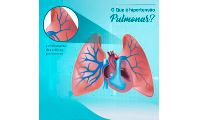 Atenção para a Hipertensão Arterial Pulmonar