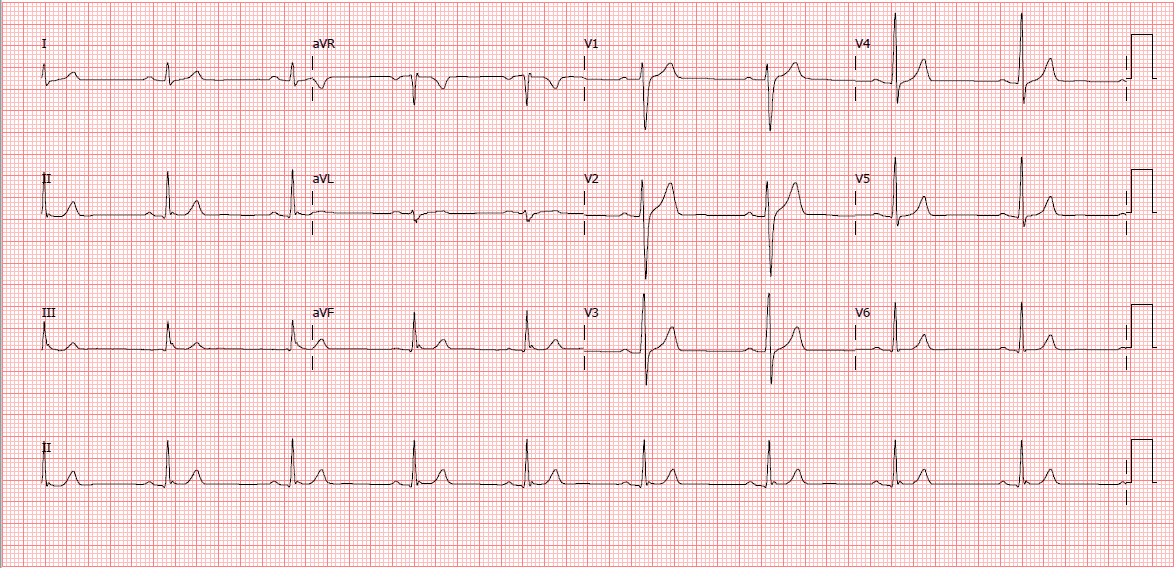 Eletrocardiograma em casa